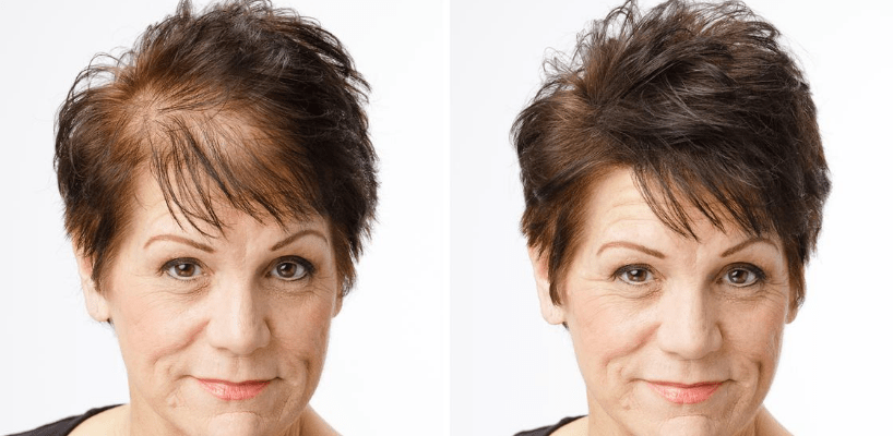 Kadınlarda Saç Ekimi Sonuçları