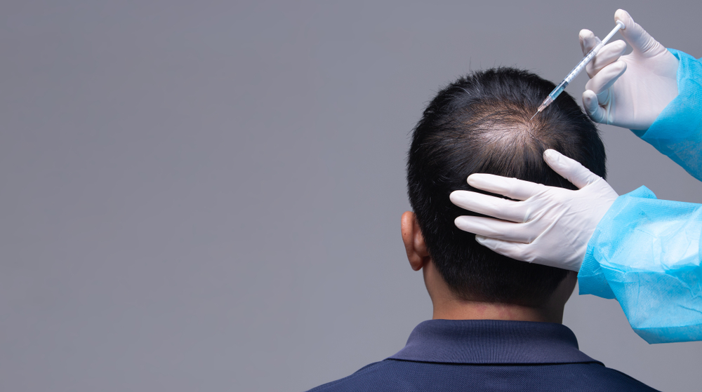 PRP Tedavisi Saç Ekimi Sonrası Kaşıntı ve Kızarıklık İçin Etkili mi?